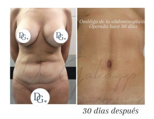 Dermolipectomía - Dr. Damián Galeazzo