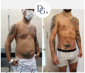 Lipoescultura con Renuvion - Dr. Damián Galeazzo
