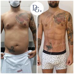 Marcación abdominal Renuvion Vaser - Dr. Damián Galeazzo