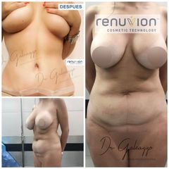 Abdominoplastia - Dr. Damián Galeazzo