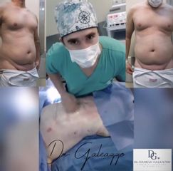Lipoescultura - Dr. Damián Galeazzo y Equipo