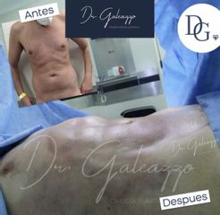 Liposucción - Dr. Damián Galeazzo y Equipo