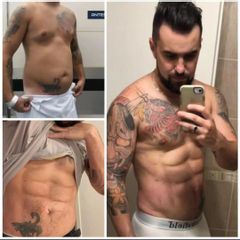 Abdominoplastia - Dr. Damián Galeazzo y Equipo