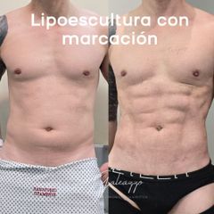 Lipoescultura en hombres - Dr. Damián Galeazzo y Equipo