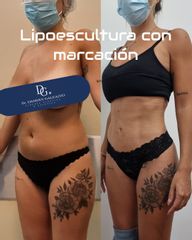 Lipoescultura - Galeazzo Cirugia & Estetica