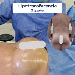 Lipotransferencia Gluteoplastia - Dr Galeazzo Cirugía Plástica | Galmed