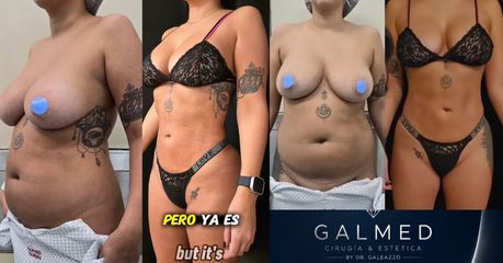 Lipoescultura sin cortes - Dr Galeazzo Cirugía Plástica | Galmed