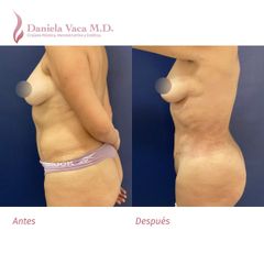 Liposucción - Dra. Daniela Stephania Vaca Grisales