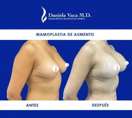 Mamoplastia de aumento - Dra. Daniela Stephania Vaca Grisales