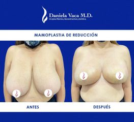 Mamoplastia de reducción - Dra. Daniela Stephania Vaca Grisales