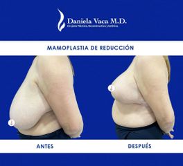 Mamoplastia de reducción - Dra. Daniela Stephania Vaca Grisales