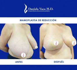 Mamoplastia de reducción - Dra. Daniela Stephania Vaca Grisales