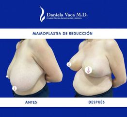 Mamoplastia de reducción - Dra. Daniela Stephania Vaca Grisales