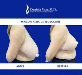 Mamoplastia de reducción - Dra. Daniela Stephania Vaca Grisales