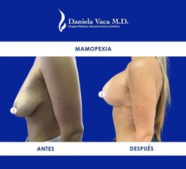 Mamopexia - Dra. Daniela Stephania Vaca Grisales