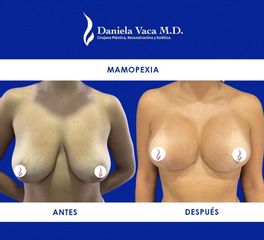 Mamopexia - Dra. Daniela Stephania Vaca Grisales