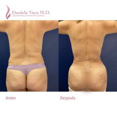Lipectomía - Dra. Daniela Stephania Vaca Grisales