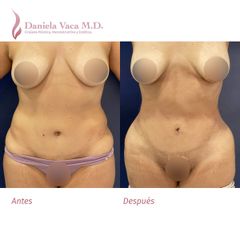 Lipectomía - Dra. Daniela Stephania Vaca Grisales
