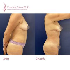 Lipectomía - Dra. Daniela Stephania Vaca Grisales