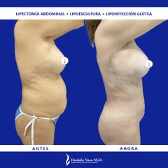 Lipectomía - Dra. Daniela Stephania Vaca Grisales