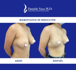 Mamoplastia de aumento - Dra. Daniela Stephania Vaca Grisales