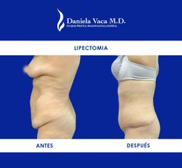 Lipectomía - Dra. Daniela Stephania Vaca Grisales