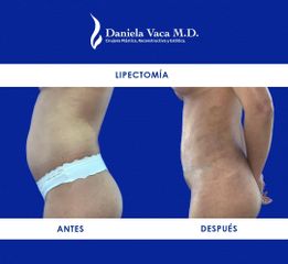 Lipectomía - Dra. Daniela Stephania Vaca Grisales
