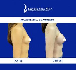 Mamoplastia de aumento - Dra. Daniela Stephania Vaca Grisales