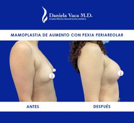 Mamoplastia de aumento - Dra. Daniela Stephania Vaca Grisales