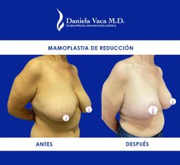 Mamoplastia de reducción - Dra. Daniela Stephania Vaca Grisales