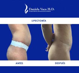 Lipectomía - Dra. Daniela Stephania Vaca Grisales