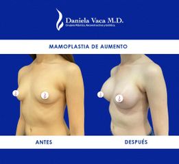 Mamoplastia de aumento - Dra. Daniela Stephania Vaca Grisales