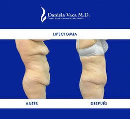 Lipectomía - Dra. Daniela Stephania Vaca Grisales