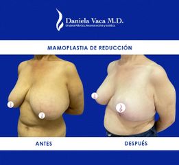 Mamoplastia de reducción - Dra. Daniela Stephania Vaca Grisales