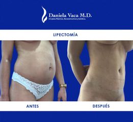 Lipectomía - Dra. Daniela Stephania Vaca Grisales