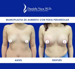 Mamoplastia de aumento - Dra. Daniela Stephania Vaca Grisales