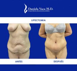 Lipectomía - Dra. Daniela Stephania Vaca Grisales