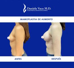 Mamoplastia de aumento - Dra. Daniela Stephania Vaca Grisales