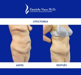 Lipectomía - Dra. Daniela Stephania Vaca Grisales