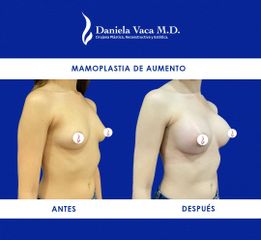 Mamoplastia de aumento - Dra. Daniela Stephania Vaca Grisales