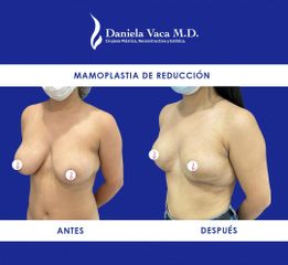 Mamoplastia de reducción - Dra. Daniela Stephania Vaca Grisales