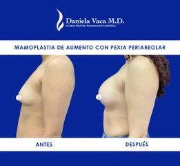 Mamoplastia de aumento - Dra. Daniela Stephania Vaca Grisales