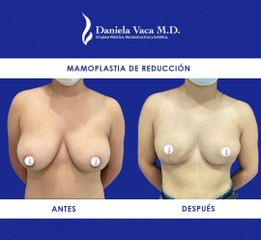 Mamoplastia de reducción - Dra. Daniela Stephania Vaca Grisales