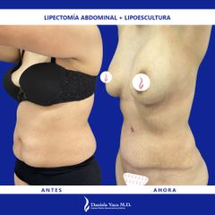 Abdominoplastia - Dra. Daniela Stephania Vaca Grisales