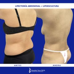 Abdominoplastia - Dra. Daniela Stephania Vaca Grisales