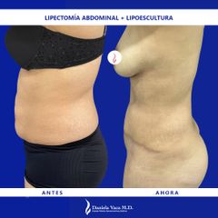 Abdominoplastia - Dra. Daniela Stephania Vaca Grisales