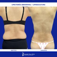 Abdominoplastia - Dra. Daniela Stephania Vaca Grisales