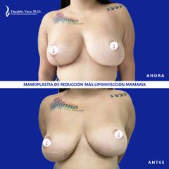 Mamoplastia de reducción - Dra. Daniela Stephania Vaca Grisales