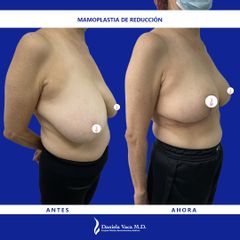 Mamoplastia de reducción - Dra. Daniela Stephania Vaca Grisales