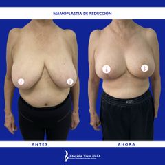 Mamoplastia de reducción - Dra. Daniela Stephania Vaca Grisales
